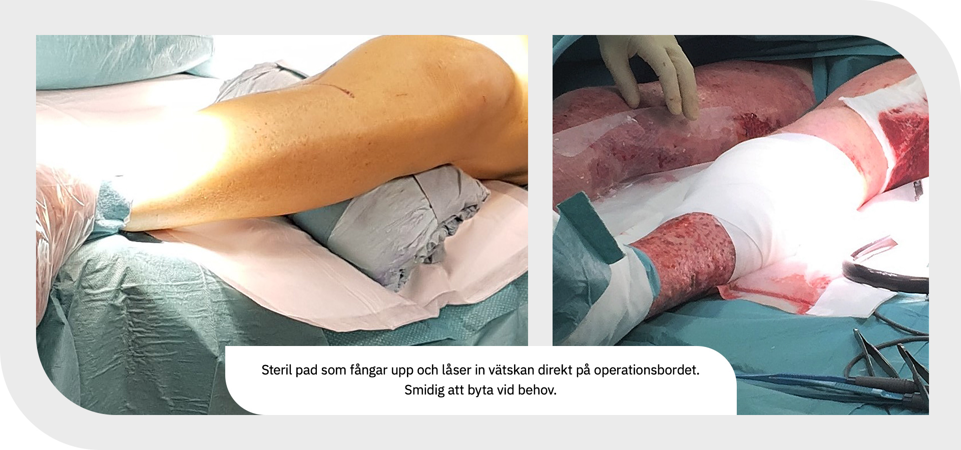 En absorberande, steril pad som fångar upp spillvätska under operation