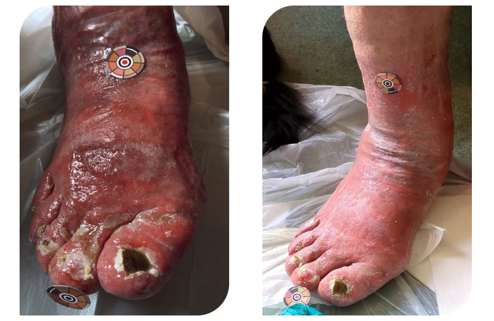 Clinical Outcomes in the Management of Toe Lymphorrhoea with a Superabsorbent Dressing