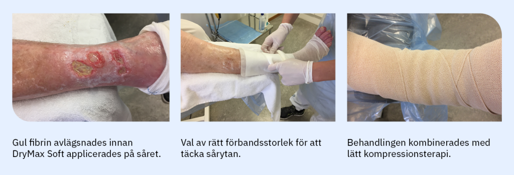behandlingsmetod blandsår. rengöring, val av förband, kompression.