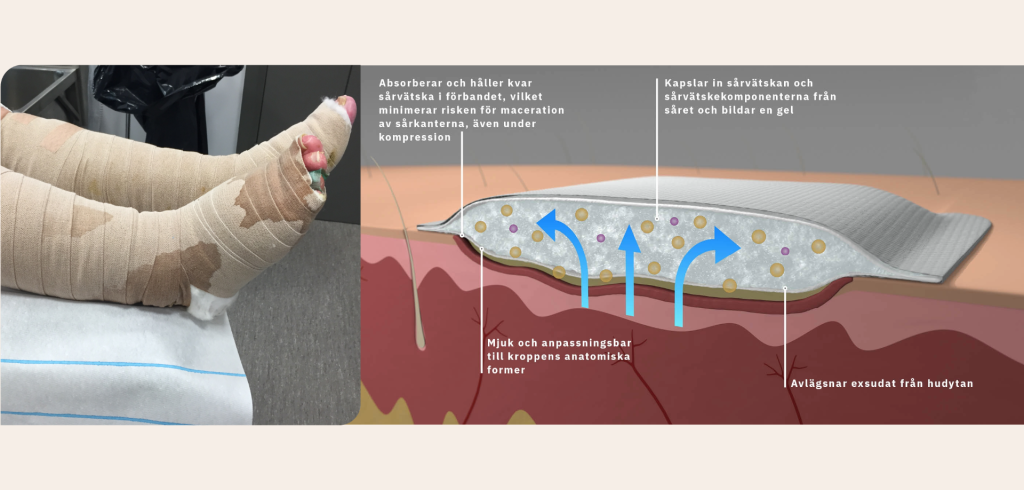 Ett superabsorberande sårförband som hanterar sårvätskan.