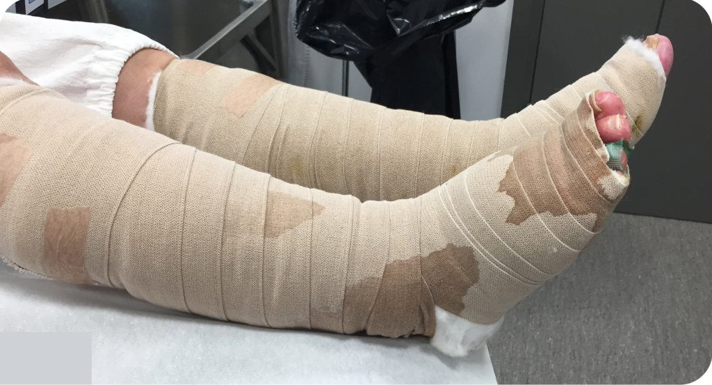 Läckage genom förband, bensår i palliativ vård.